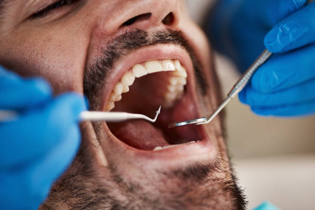 Best Emergency Tooth Extraction in Blue Hills, CT